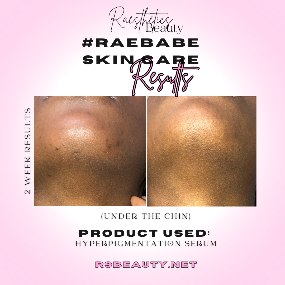 Hyperpigmentation Serum